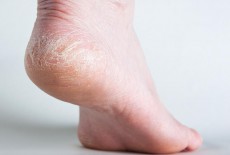 6 cách chữa trị nứt nẻ tay chân vào mùa đông